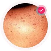 Солнечные пигментные пятна